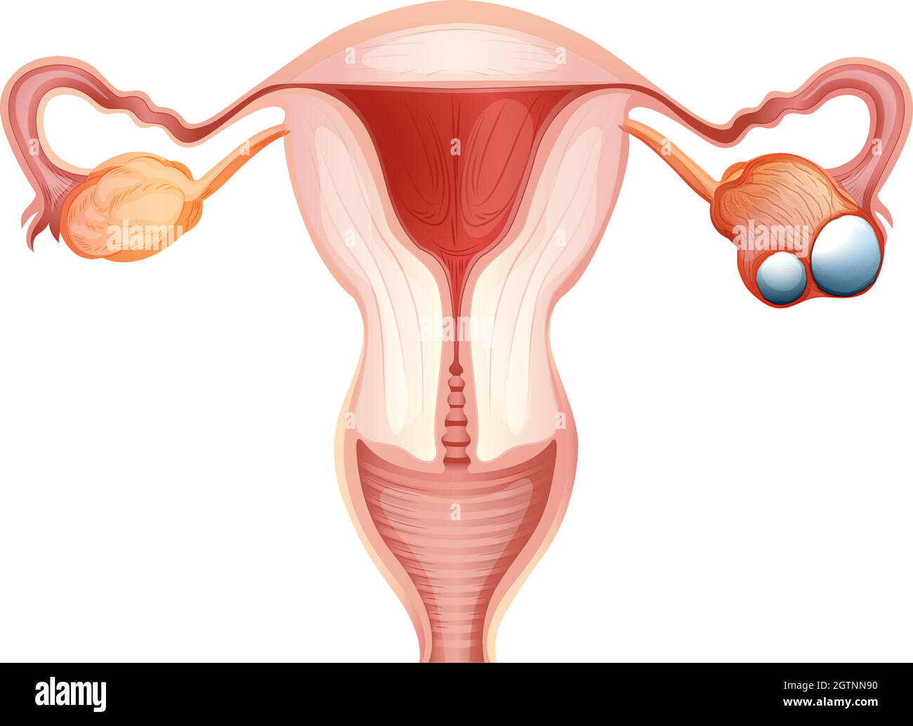 Diagramm des Eierstockkrebses bei der Frau Stock Vektor