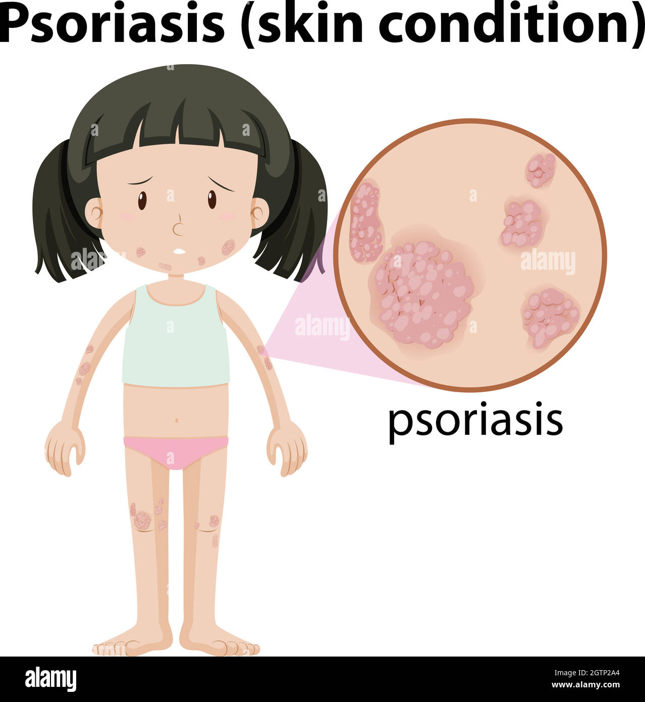 Ein Mädchen Havimg Psoriasis auf der Haut Stock Vektor