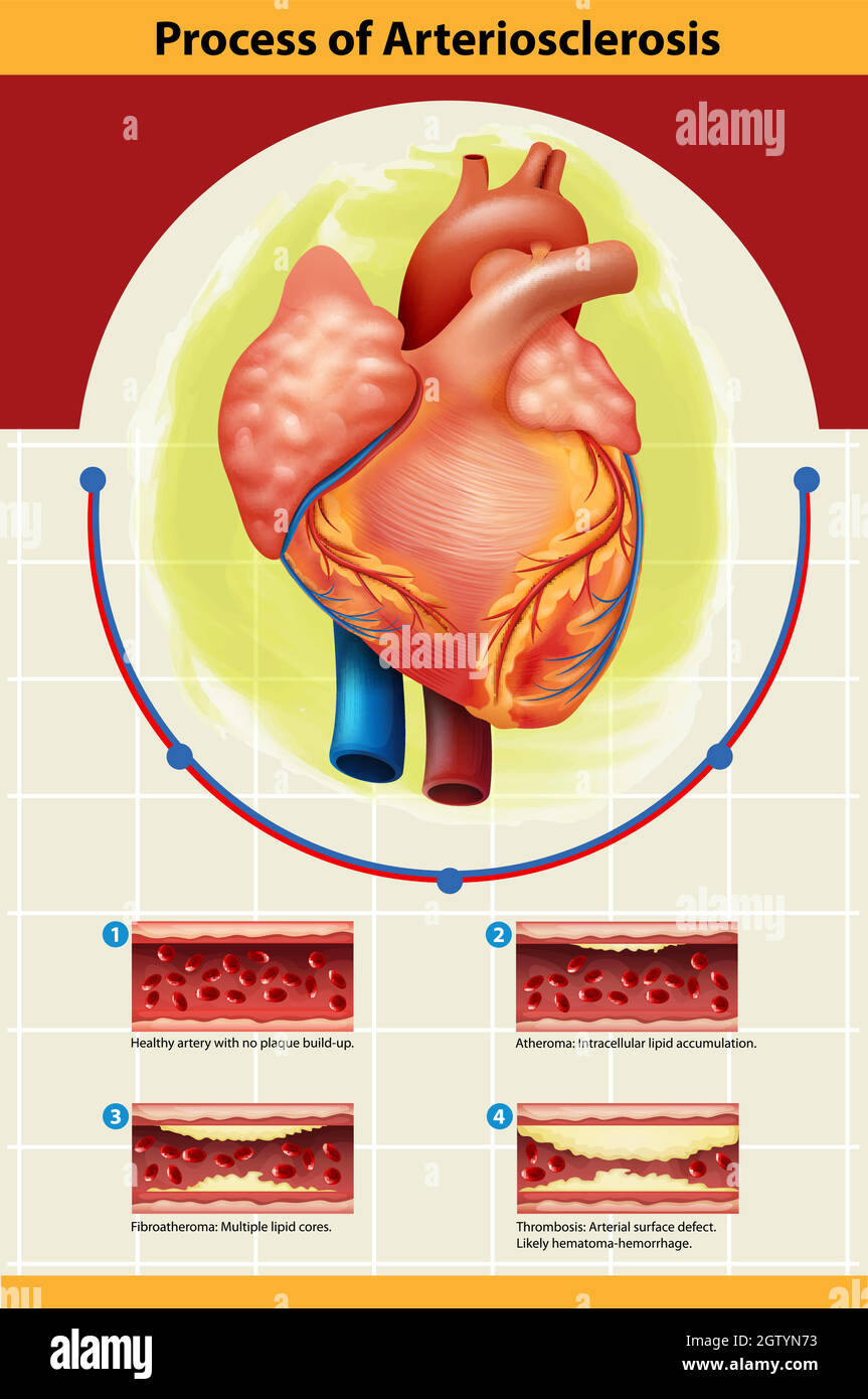 Poster des Arteriosklerose-Prozesses Stock Vektor