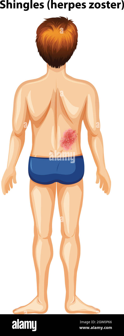 Ein Mann mit Gürtelrose im Rücken Stock Vektor