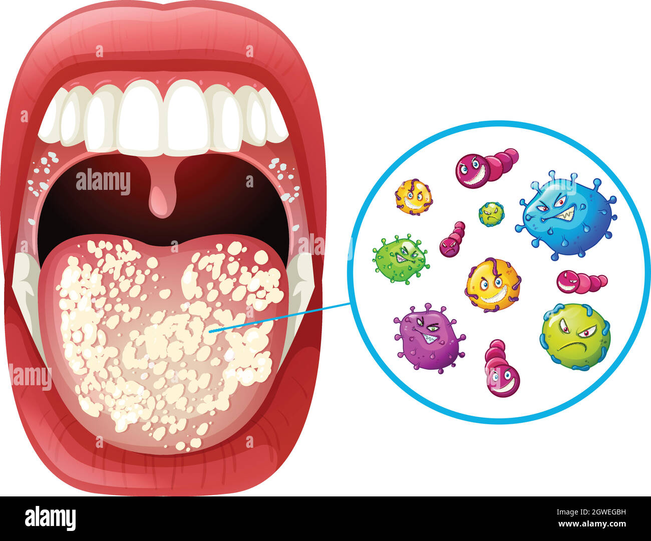 Eine Infektion mit dem Human Mouth Virus Stock Vektor