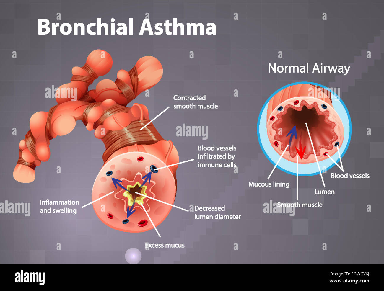 Asthma entzündete Bronchien Stock Vektor