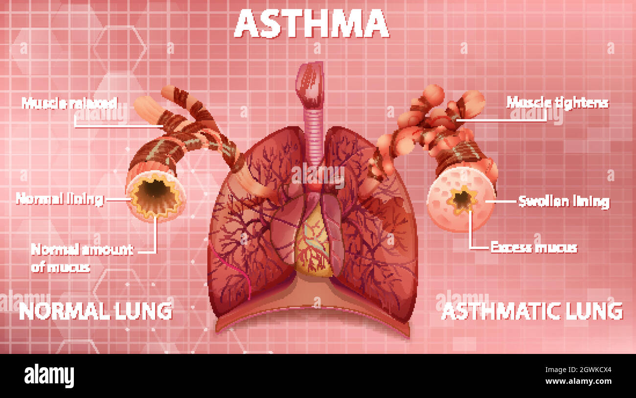 Vergleich von gesunder Lunge und asthmatischer Lunge Stock Vektor