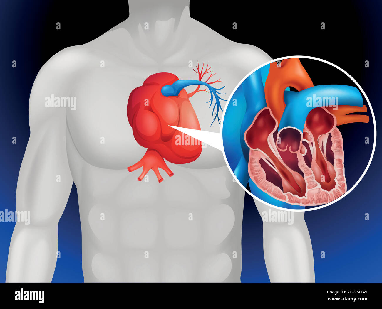 Herzerkrankungen Diagramm im Detail Stock Vektor