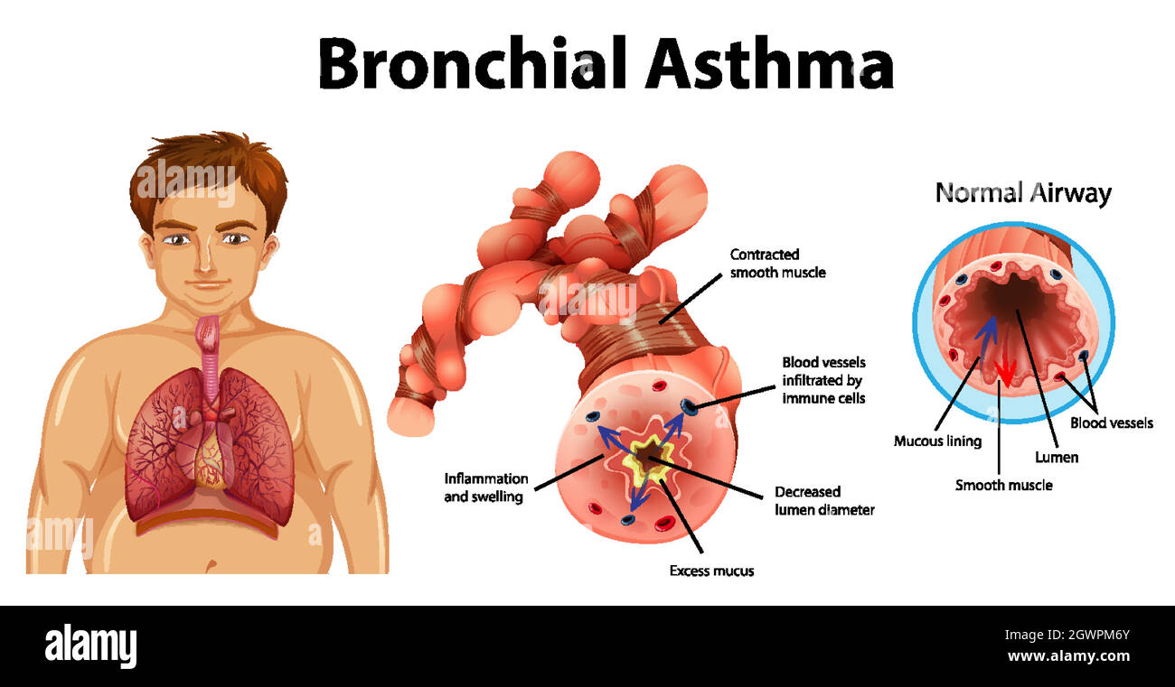 Asthma entzündete Bronchien Stock Vektor