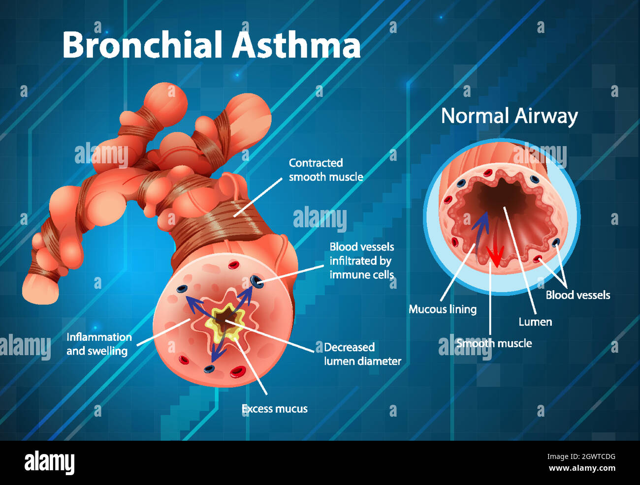 Asthma entzündete Bronchien Stock Vektor