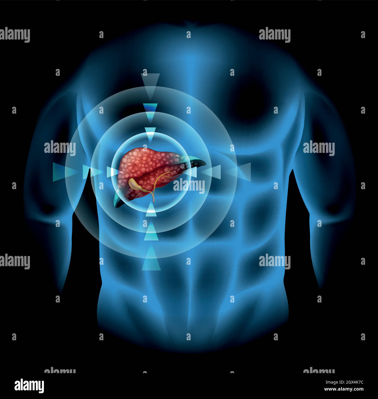 Sklerose Diagramm im menschlichen Körper Stock Vektor
