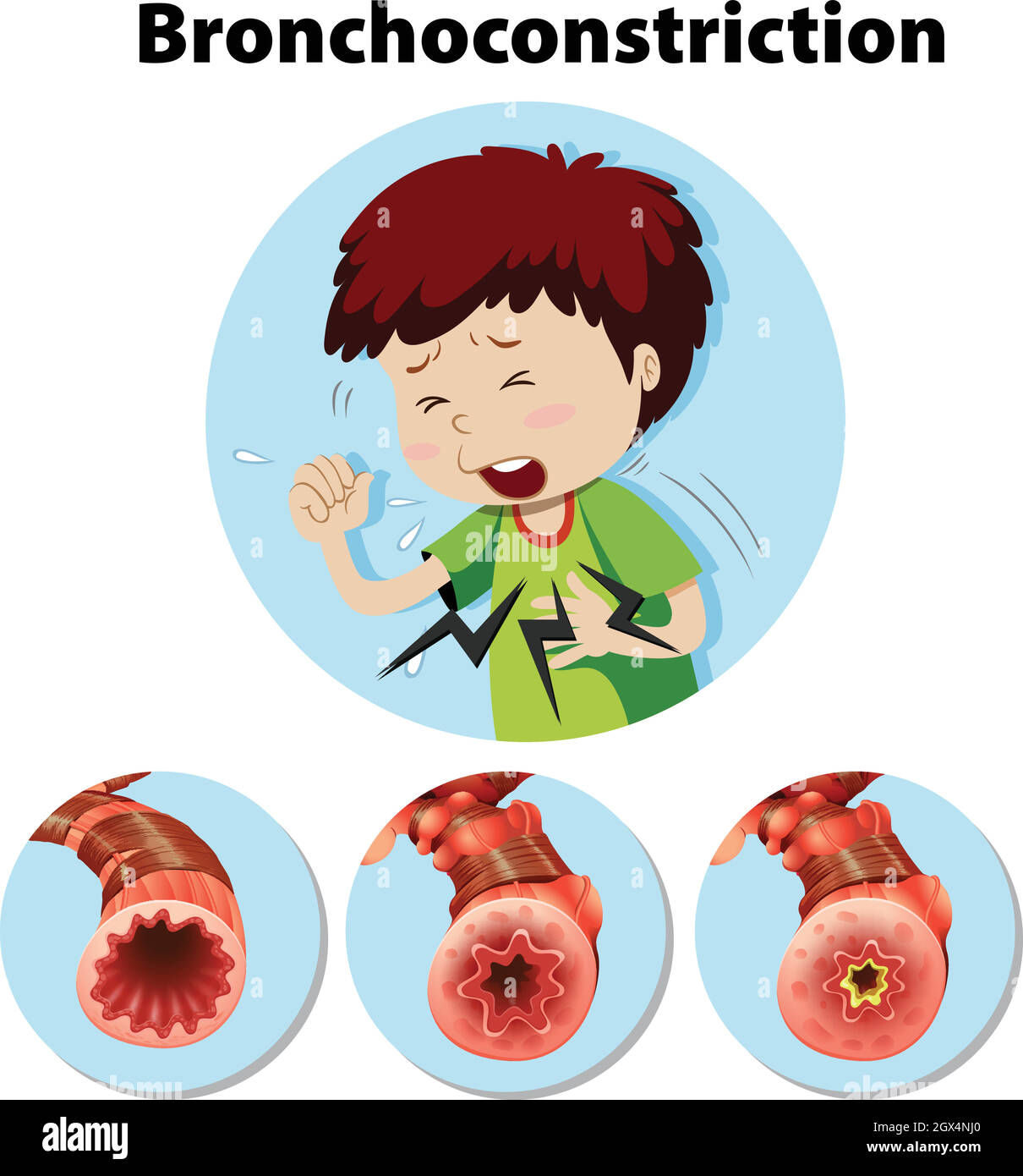 Menschliche Anatomie Bronchokonstriktion auf weißem Hintergrund Stock Vektor