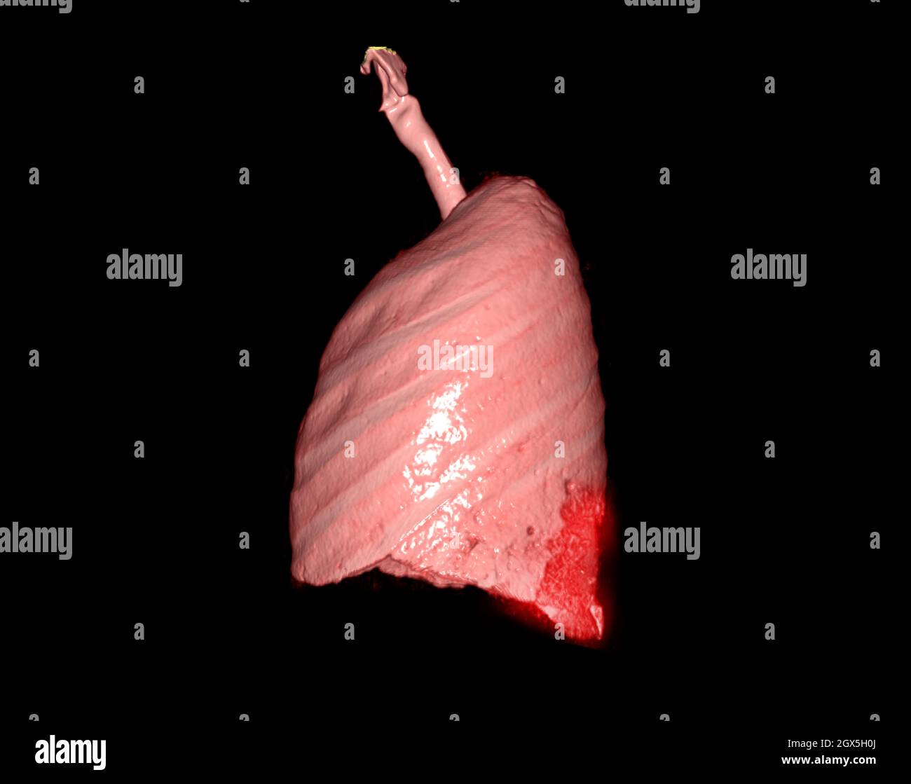 3d-Renderings der lateralen Ansicht der menschlichen Lunge, die eine Infektion des Atmungssystems zeigt. Stockfoto