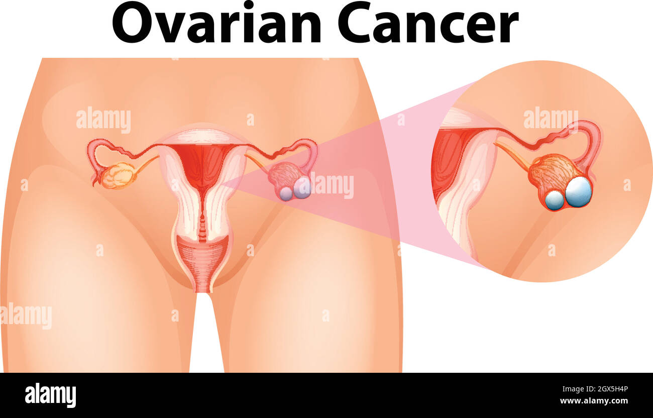 Diagramm mit Eierstockkrebs Stock Vektor