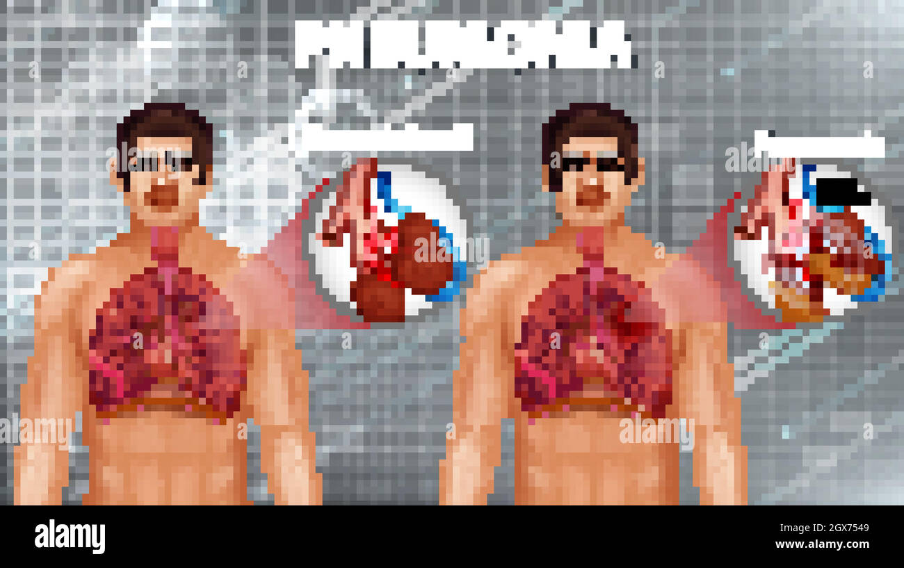 Menschliche Anatomie, die eine Lungenentzündung zeigt Stock Vektor