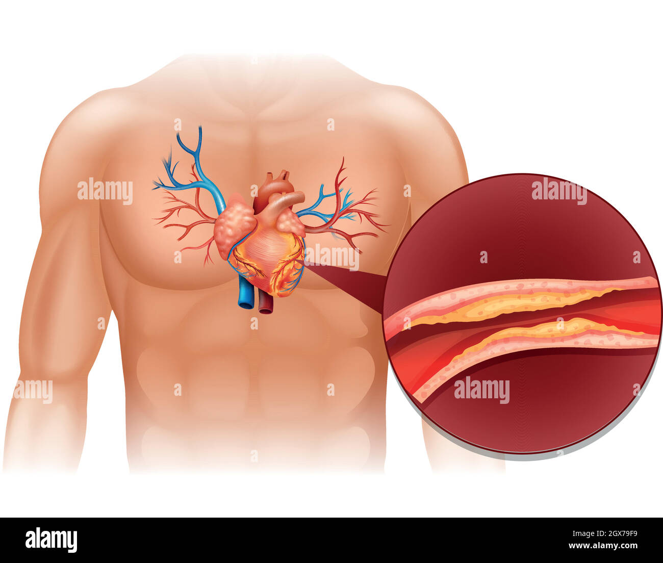 Herzcholeral im menschlichen Körper Stock Vektor