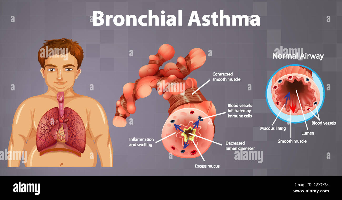 Asthma entzündete Bronchien Stock Vektor