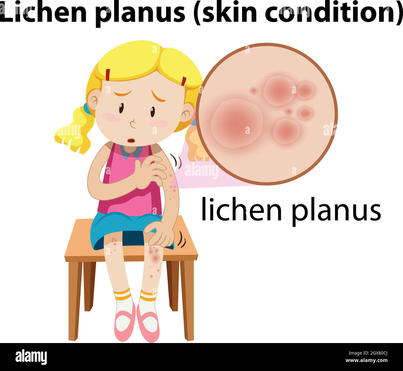 Flechten planus versteinert auf Mädchen Stock Vektor