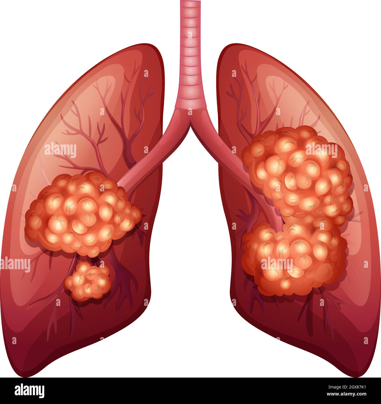 Lungenkrebsverfahren im Detail Stock Vektor