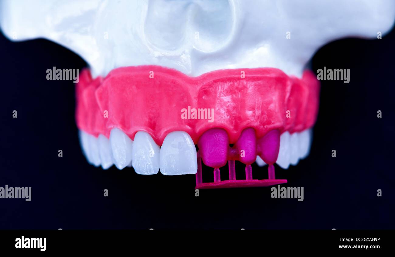 Zähne Implantat und Krone Installation auf einem blauen Hintergrund isoliert. Medizinisch genaue 3D-Darstellung Stockfoto