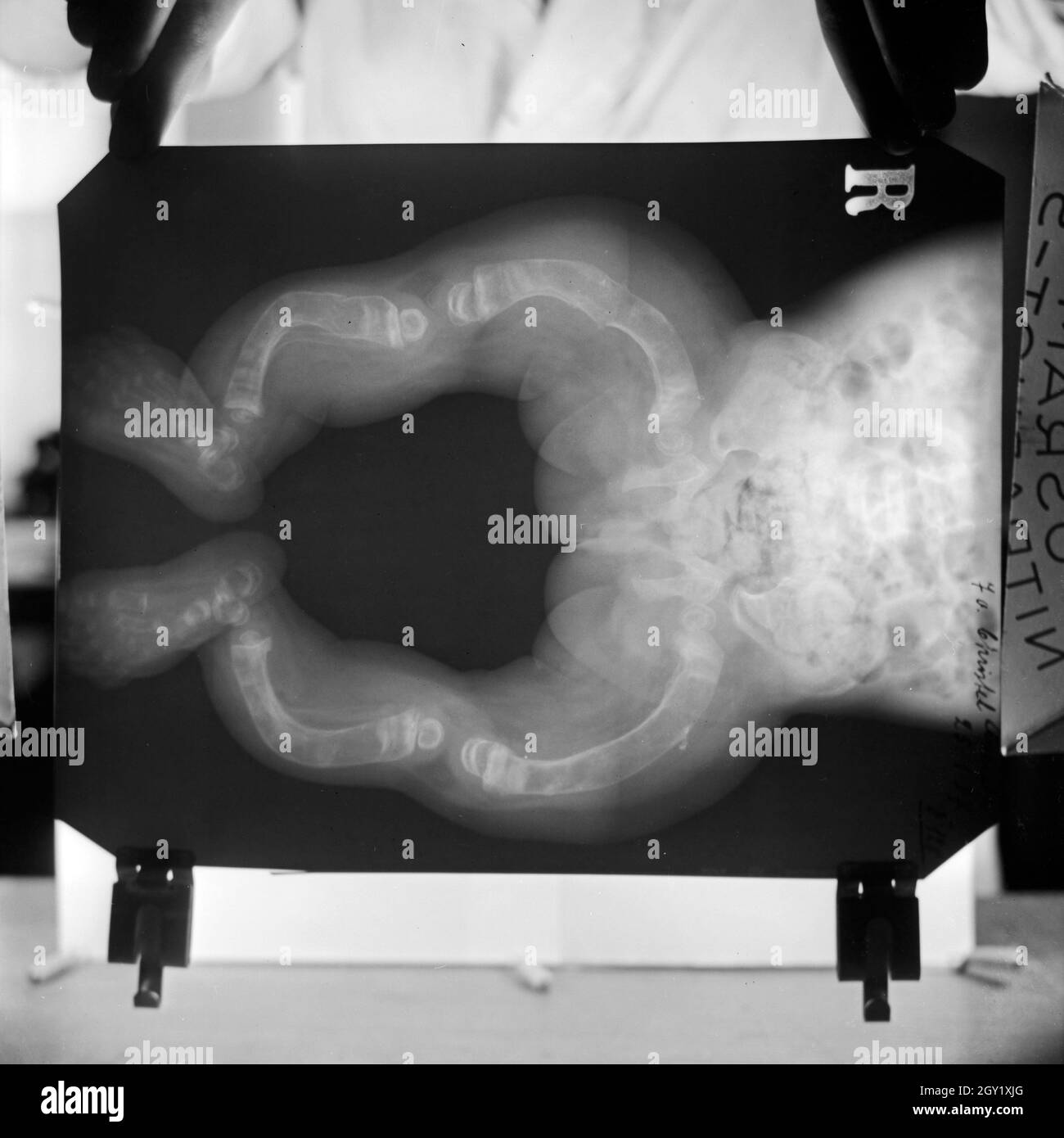 Reproduktion eines Röntgenbilds der deformierten Knochen eines Kleinkinds, Deutschland 1930er Jahre. Reproduktion von einem röntgenbild von verformten Beinknochen eines Kindes, Deutschland 1930. Stockfoto