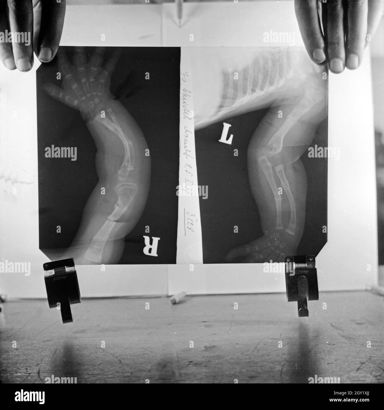 Reproduktion von Röntgenbildern der deformierten Knochen eines Kleinkinds, Deutschland 1930er Jahre. Die Vervielfältigung von Röntgenaufnahmen von verformten Arm- und Beinknochen eines Kindes, Deutschland 1930. Stockfoto