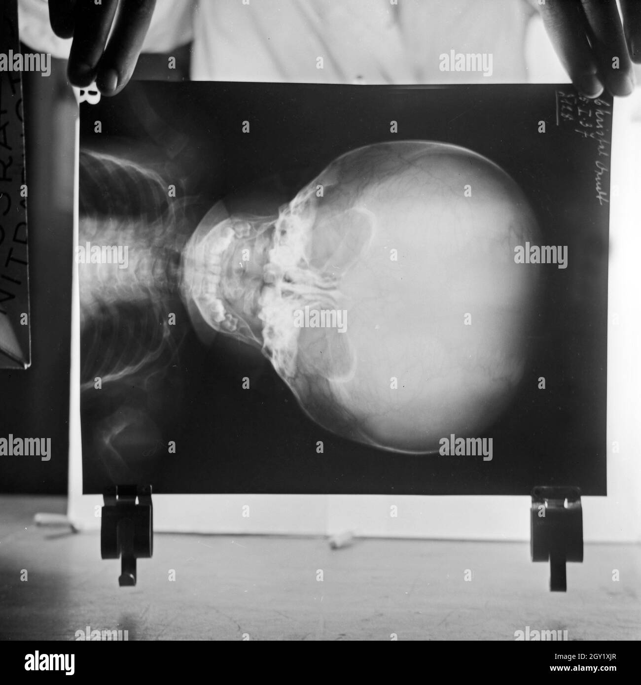 Reproduktion eines Röntgenbilds des Wasserkopfes bei einem Kleinkind, Deutschland 1930er Jahre. Nachbildung einer Röntgenaufnahme des hydrocephalus eines Kindes, Deutschland 1930. Stockfoto
