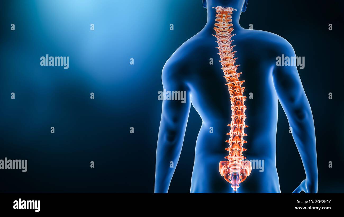 Krümmung der Wirbelsäule und der Rückenansicht des menschlichen Körpers 3D-Rendering-Illustration mit Kopierraum. Wirbelsäulenerkrankung oder -Deformität, Skoliose, Wirbelsäulenverletzung, Huma Stockfoto