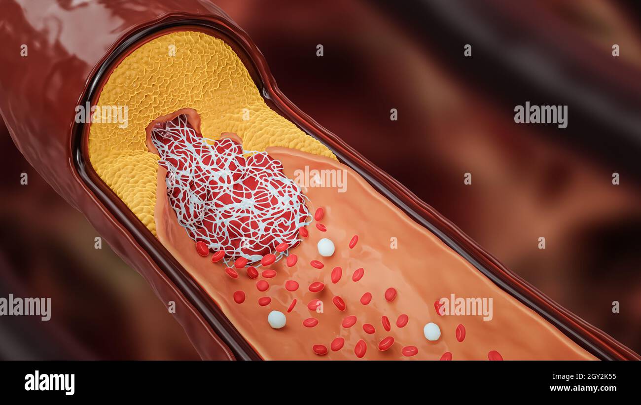 Krankhafte Arterie oder Blutgefäß, verstopft durch Cholesterin- oder Atheroma-Plaque und Blutgerinnsel, 3D-Darstellung. Chirurgie, Medizin, Kardiologie, hea Stockfoto