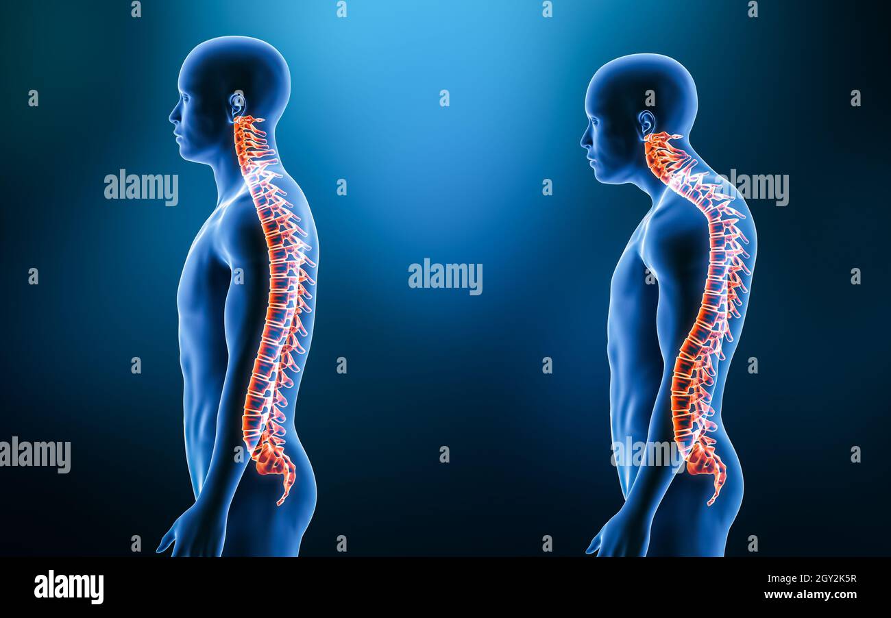 Vergleich zwischen der normalen Wirbelsäulenkrümmung und der Kyphose mit dem männlichen Modell aus der lateralen 3D-Darstellung. Menschliche Anatomie, Rückenmarksverletzung Stockfoto