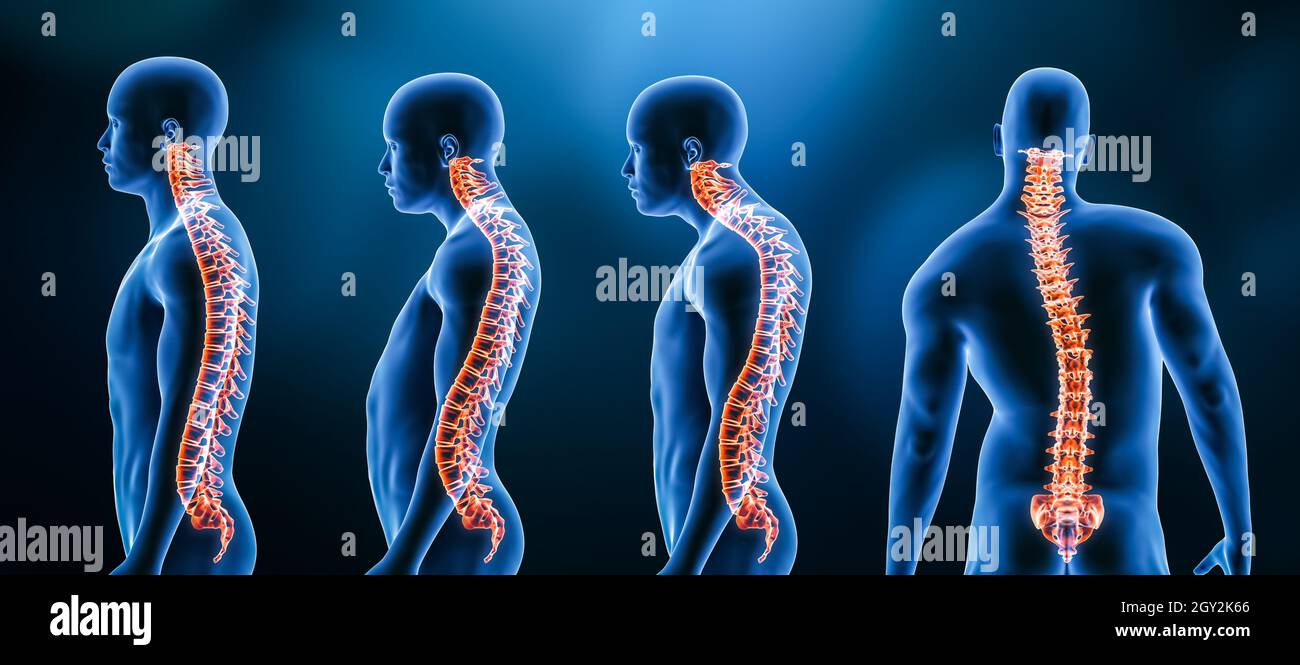 Drei Hauptkurvaturen der Wirbelsäulenerkrankungen oder Fehlbildungen am männlichen Körper: Lordose, Kyphose und Skoliose 3D-Darstellung. Menschliche Anatomie, b Stockfoto
