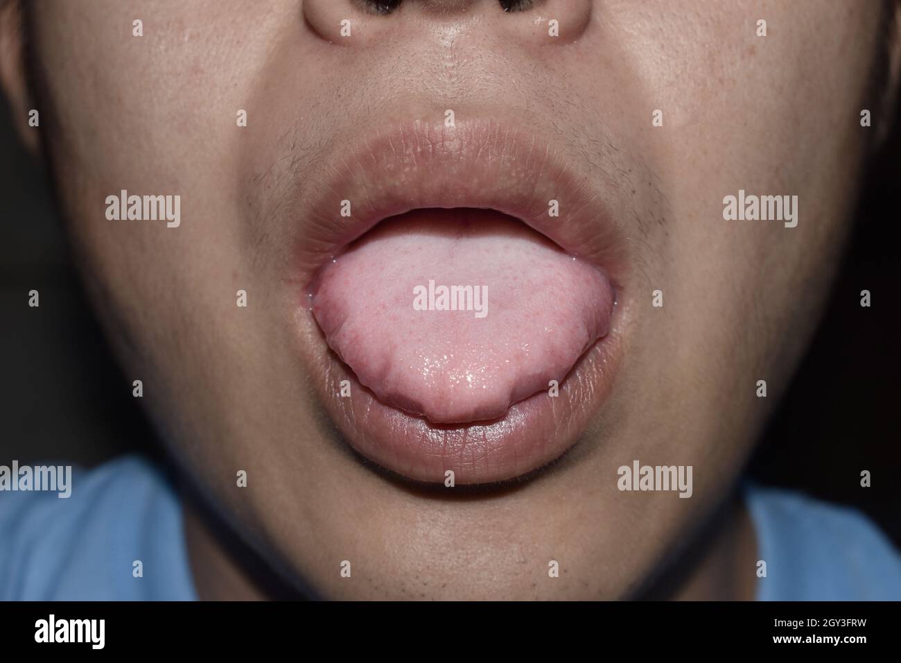Beschichtete Zunge oder weiße Zunge eines asiatischen, chinesischen Mannes. Es erscheint mit einer weißen Schicht, wenn sich Rückstände, Bakterien und abgestorbene Zellen zwischen vergrößertem p absetzen Stockfoto