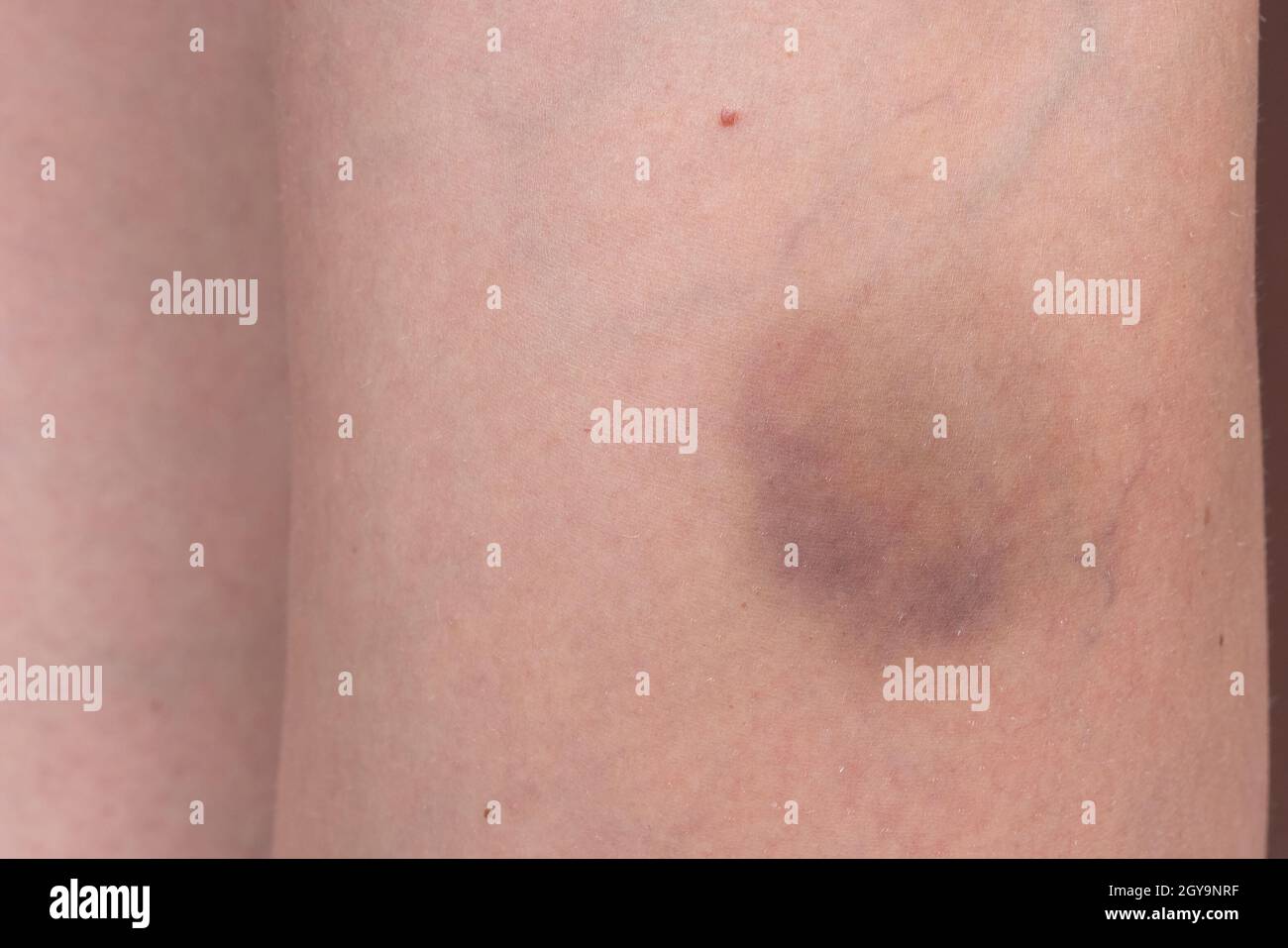 Großes Hämatom, Bluterguss am Bein der Frau, Schmerzkonzept aus der Nähe. Stockfoto