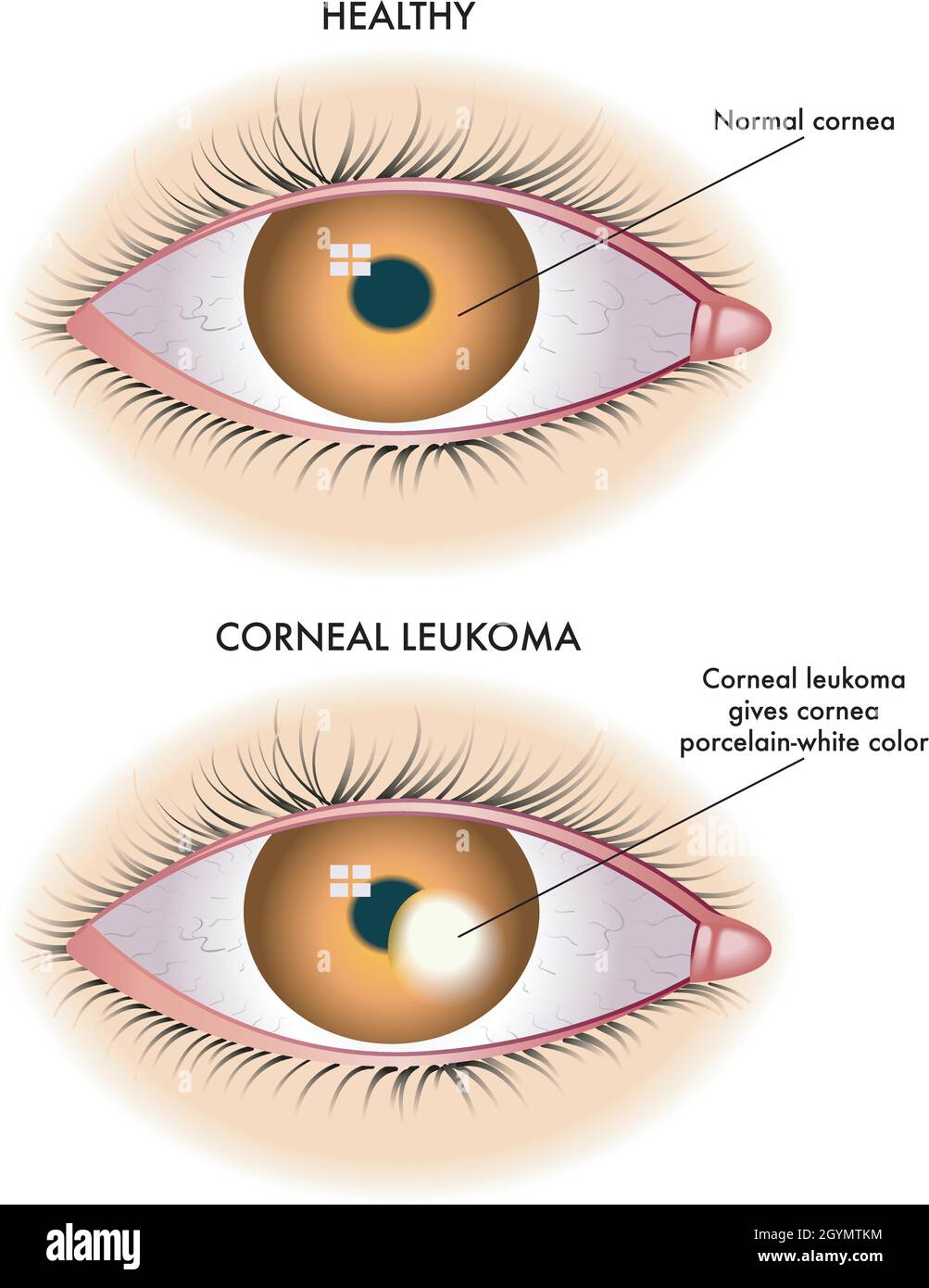 Die medizinische Illustration zeigt den Vergleich zwischen einem normalen Auge und einem von kornealem Leukoma betroffenen Auge. Stock Vektor