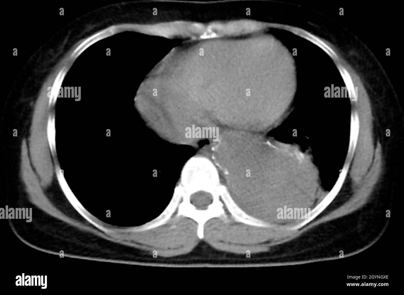 Aortenaneurysma, CT-Scan Stockfoto