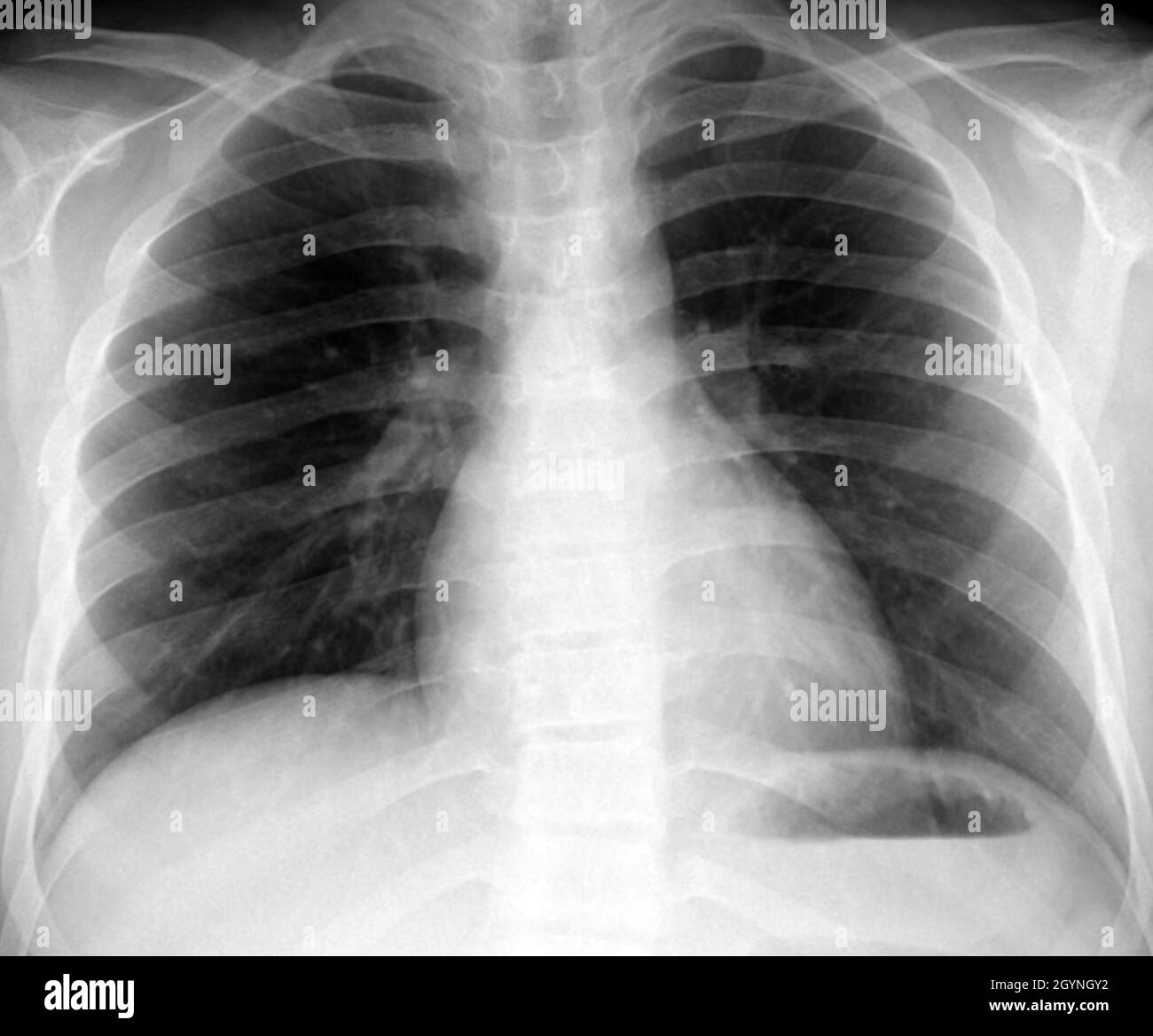 Gesunde Lunge, Röntgen Stockfotografie - Alamy