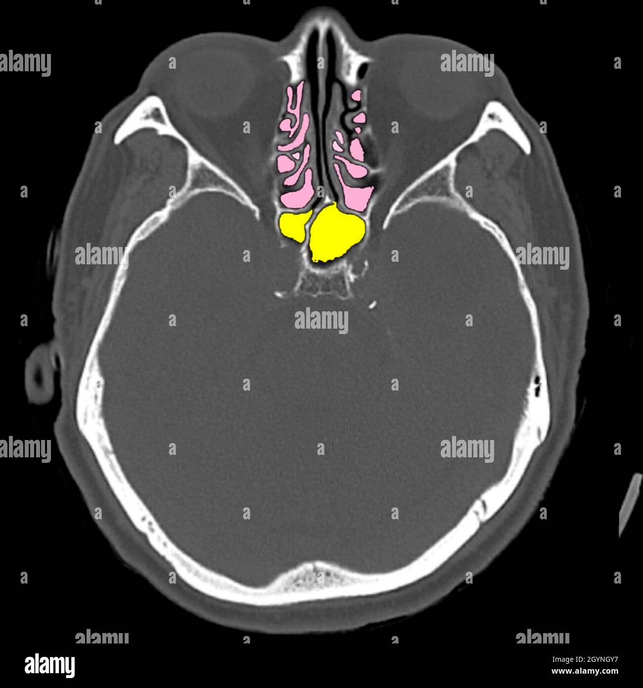 Anatomie des paranasalen Sinus, CT-Scan Stockfoto