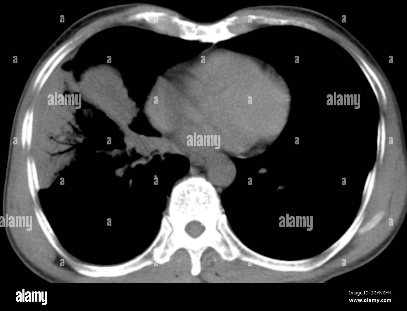Lungenkrebs, CT-Scan Stockfoto