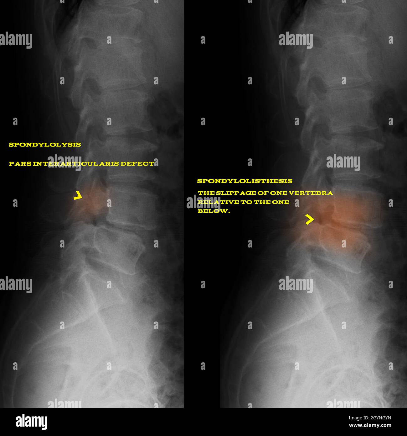 Spondylolyse und Spondylolisthese, Röntgenstrahlen Stockfoto