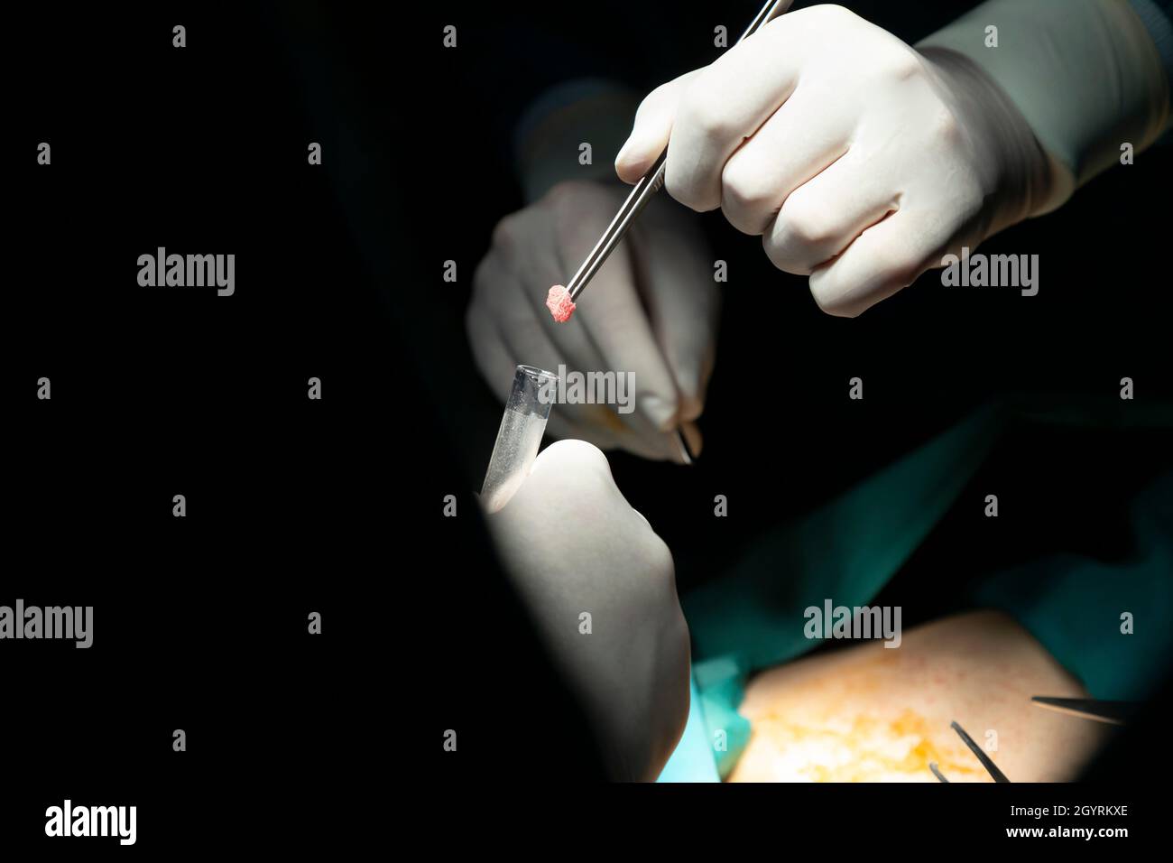 Konzentrierter professioneller chirurgischer Arzt Team Operation Chirurgie ein Patient im Operationssaal im Krankenhaus. Tumor Krebs. Chirurgische Biopsie Proben. Stockfoto