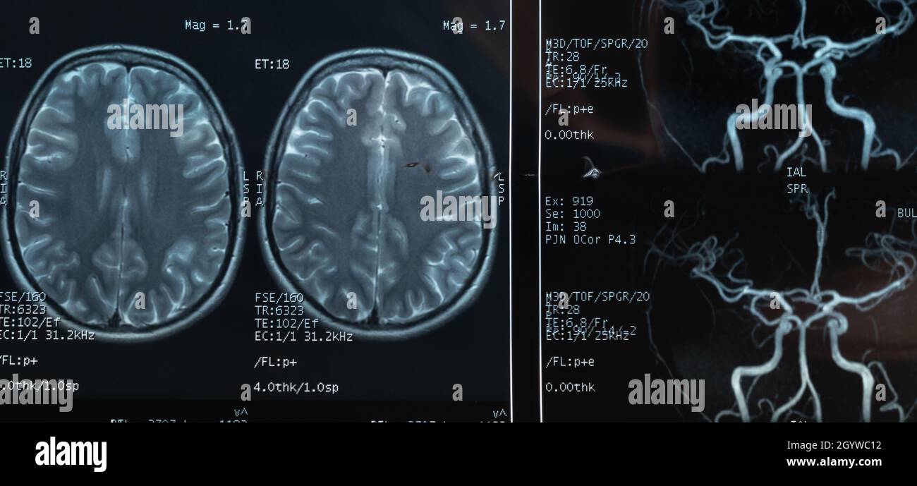 Nahaufnahme einer MRT des Gehirns und der Blutgefäße einer Person mit schweren Kopfschmerzen; magnetische und nukleare Resonanz und Angiographie als Diagnose. Stockfoto