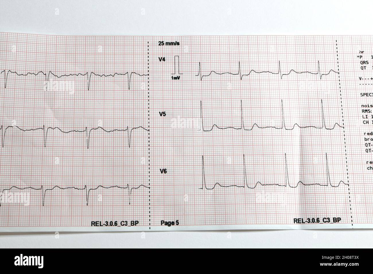 EKG-Ausdruck eines Patientenbesuchs durch Rettungskräfte Stockfoto