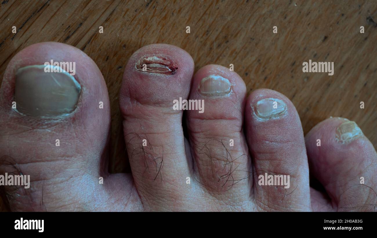Fuß mit verletzten Zehen. Der lange Zeh hat einen abgelösten Zehennagel. Der Fuß wurde nicht gepflegt. Stockfoto