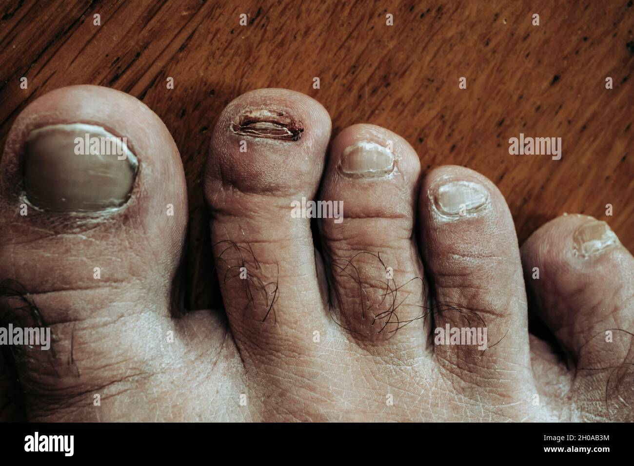Fuß mit verletzten Zehen. Der lange Zeh hat einen abgelösten Zehennagel. Der Fuß wurde nicht gepflegt. Stockfoto