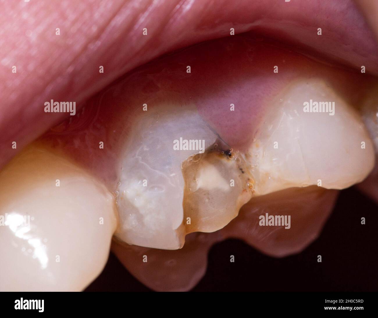 Ein schwarzer toter Zahn, bei dem ein Stück Zahnschmelz abgeschlagen wird,  ein Zahnspan. Das Konzept der Zahnrestauration in der modernen Zahnmedizin,  Makro. Orthod Stockfotografie - Alamy