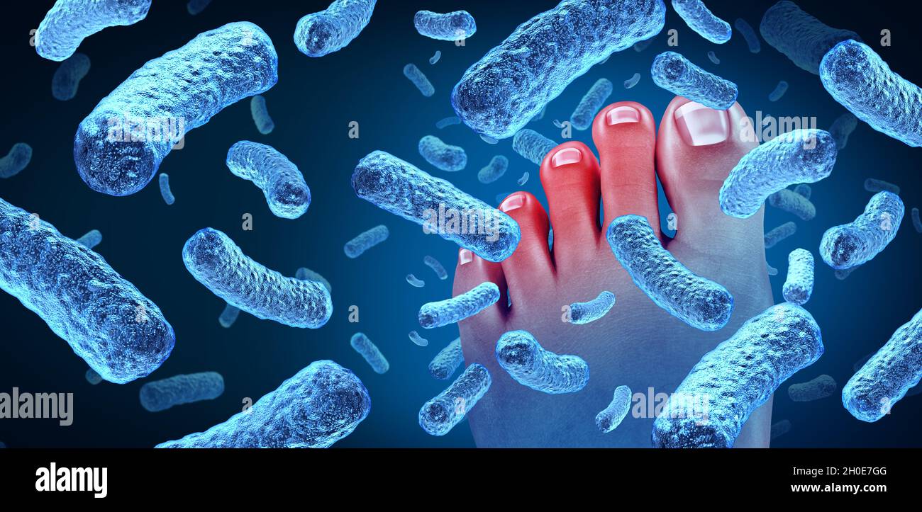 Fußbakterienerkrankung, die einen übelriechenden Geruch verursacht, wie ein menschlicher Körper, der Zehen mit bakterieller Infektionsgefahr als Symbol für Hautkrankheiten als Podologie zeigt. Stockfoto