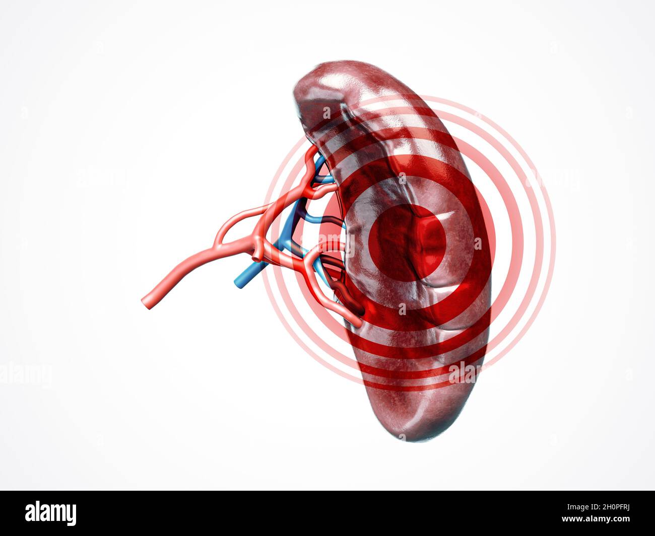 Anatomisch genaue 3d-Darstellung der Milz des menschlichen inneren Organs mit Arterie der Blutgefäße und Venen mit Krankheit auf Weiß isoliert Stockfoto