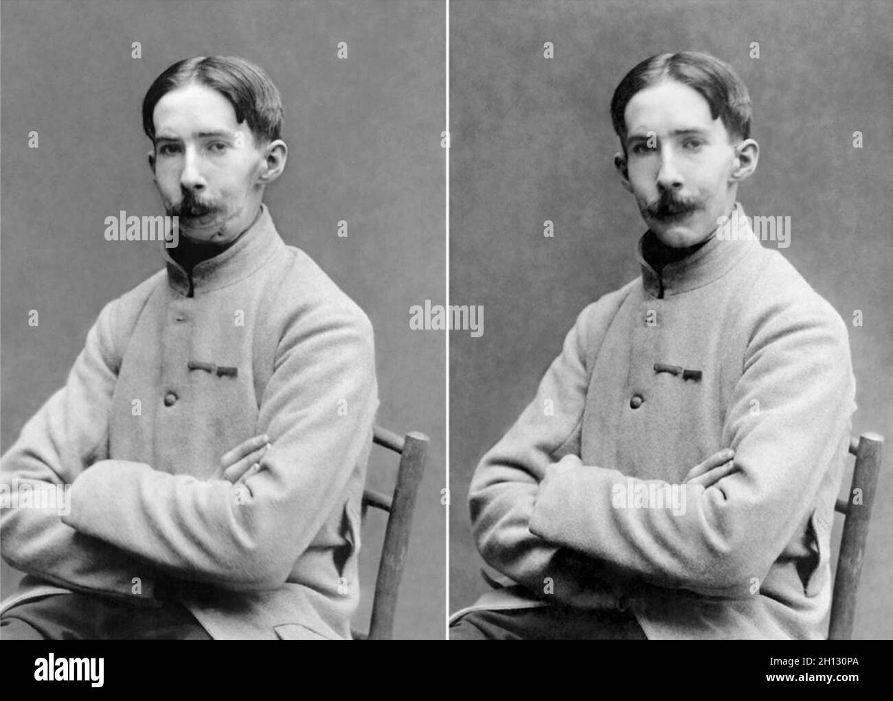 Ein vorher-Nachher-Foto mit einem französischen Soldaten, dessen Gesicht im Ersten Weltkrieg verstümmelt wurde, in einer Maske, die im Studio des amerikanischen Roten Kreuzes von Anna Coleman Ladd, 1918, angefertigt wurde. Stockfoto