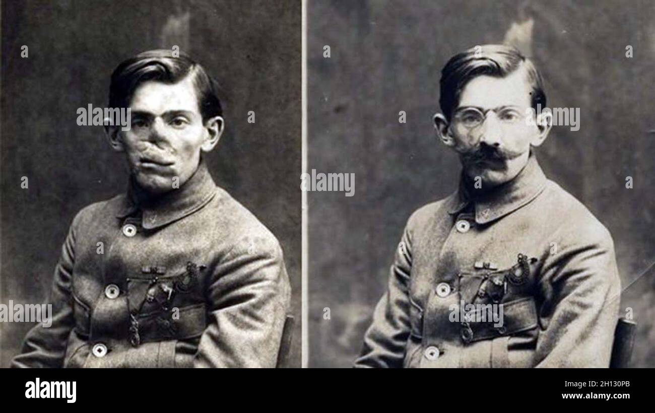 Ein vorher-Nachher-Foto mit einem französischen Soldaten, dessen Gesicht im Ersten Weltkrieg verstümmelt wurde, in einer Maske, die im Studio des amerikanischen Roten Kreuzes von Anna Coleman Ladd, 1918, angefertigt wurde. Stockfoto