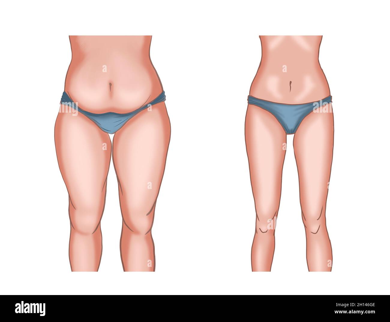 Abbildung vor und nach dem Abnehmen Stockfoto