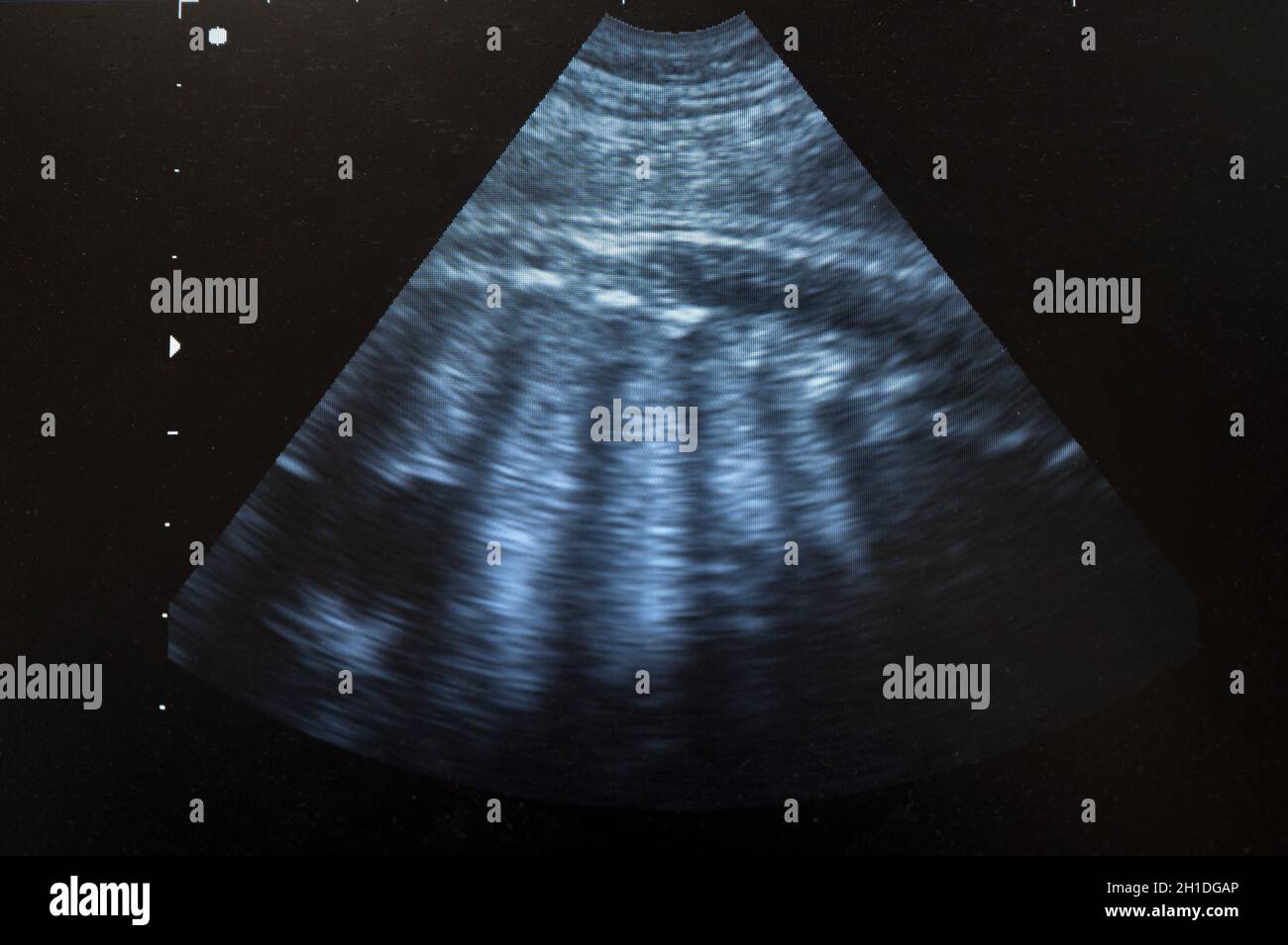 Ultraschall-Ultraschall-Ultraschall-Echographie von schwangeren Frauen. Stockfoto