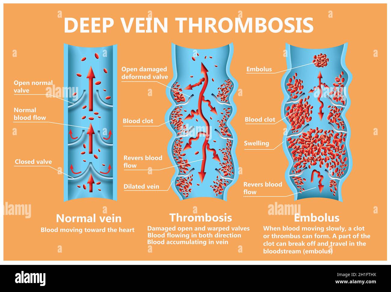 Thrombose. Von den normalen Blutfluss zu Blutgerinnsel und Blutgerinnsel, die durch den Blutstrom reist. Embolie. Abbildung für Biologische, medi Stockfoto