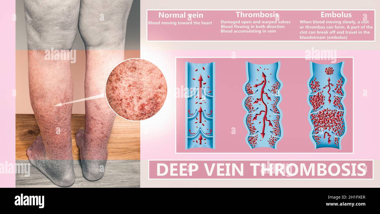 Collage über Krampfadern und hyperpigmentierte untere Extremitäten infolge venöser Insuffizienz. Illustration wurde von mir erstellt Stockfoto