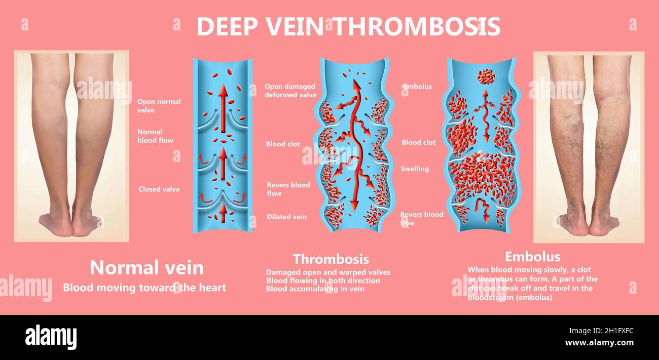 Thrombose. Von den normalen Blutfluss zu Blutgerinnsel und Blutgerinnsel, die durch den Blutstrom reist. Embolie. biologischen, medizinischen und Wissenschaft Stockfoto